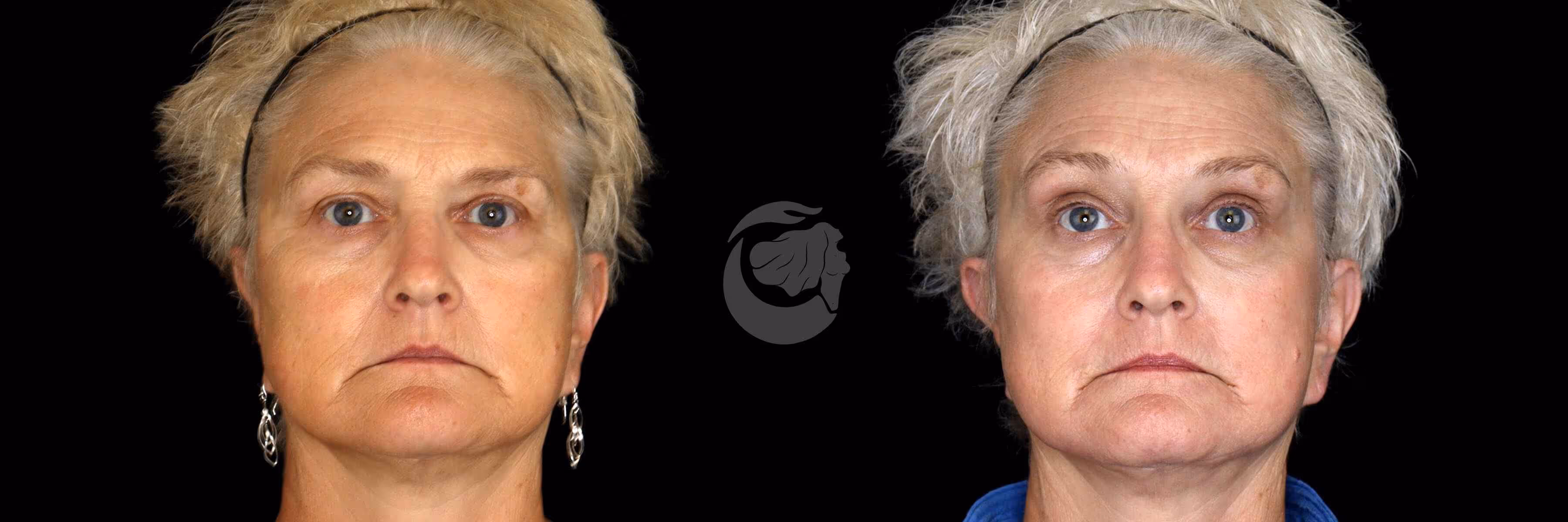 Before And After Patient Image