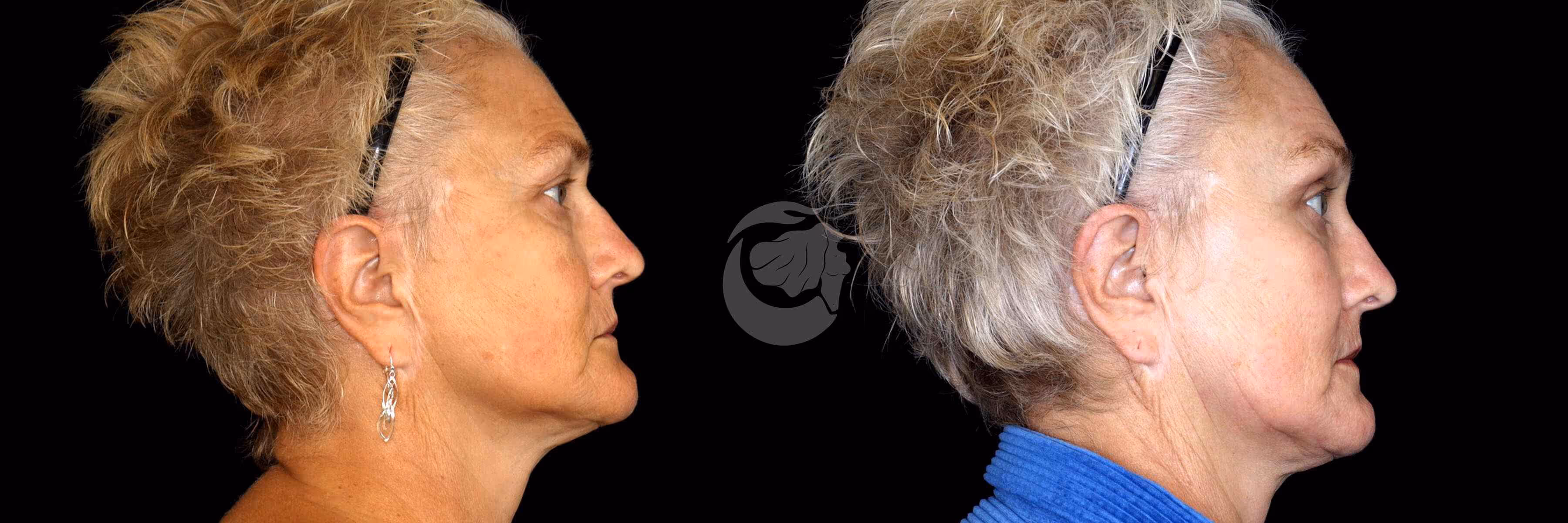 Before And After Patient Image