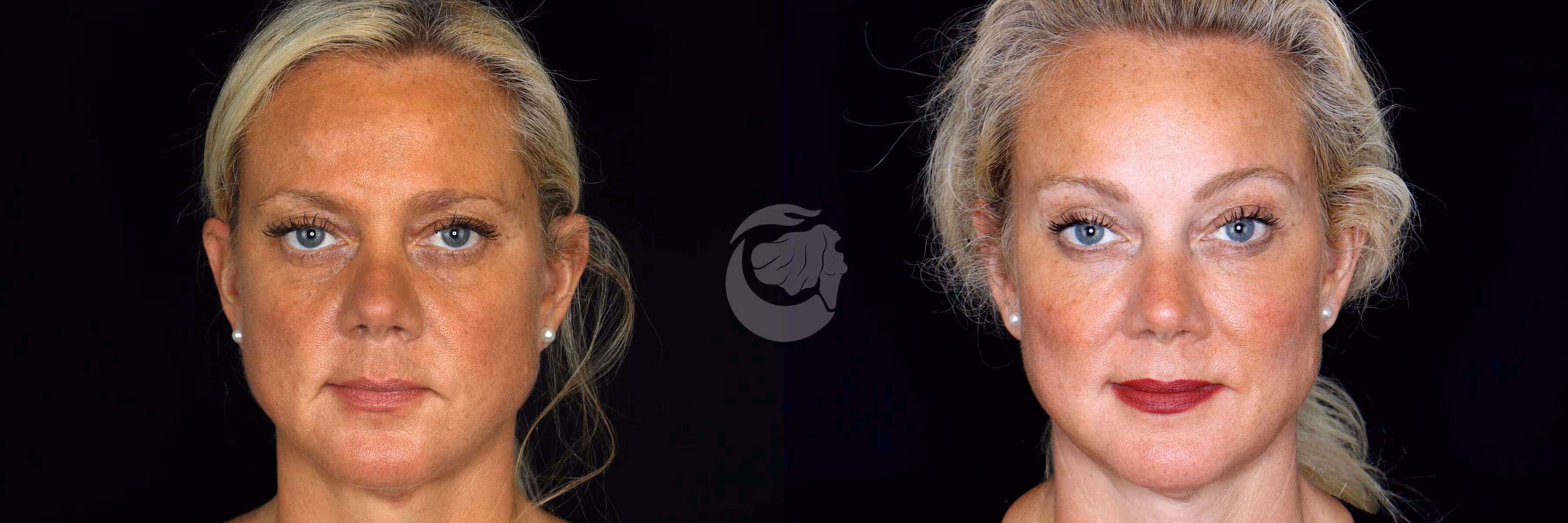 Before And After Patient Image