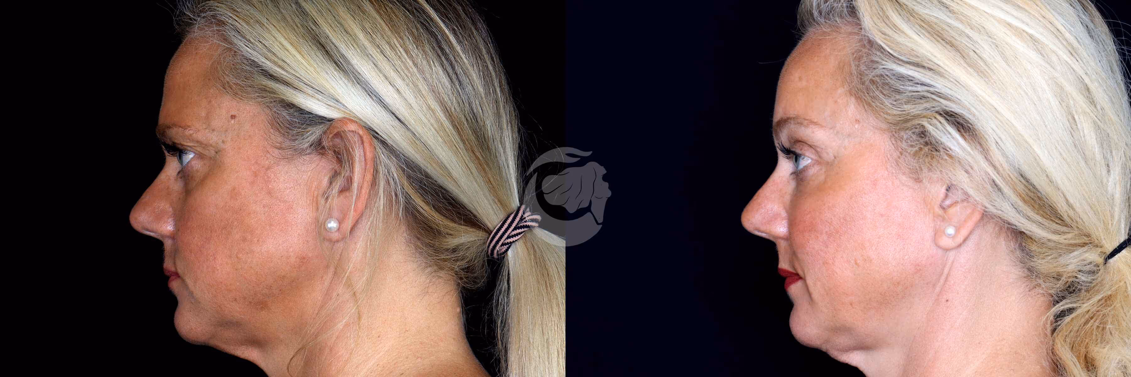 Before And After Patient Image