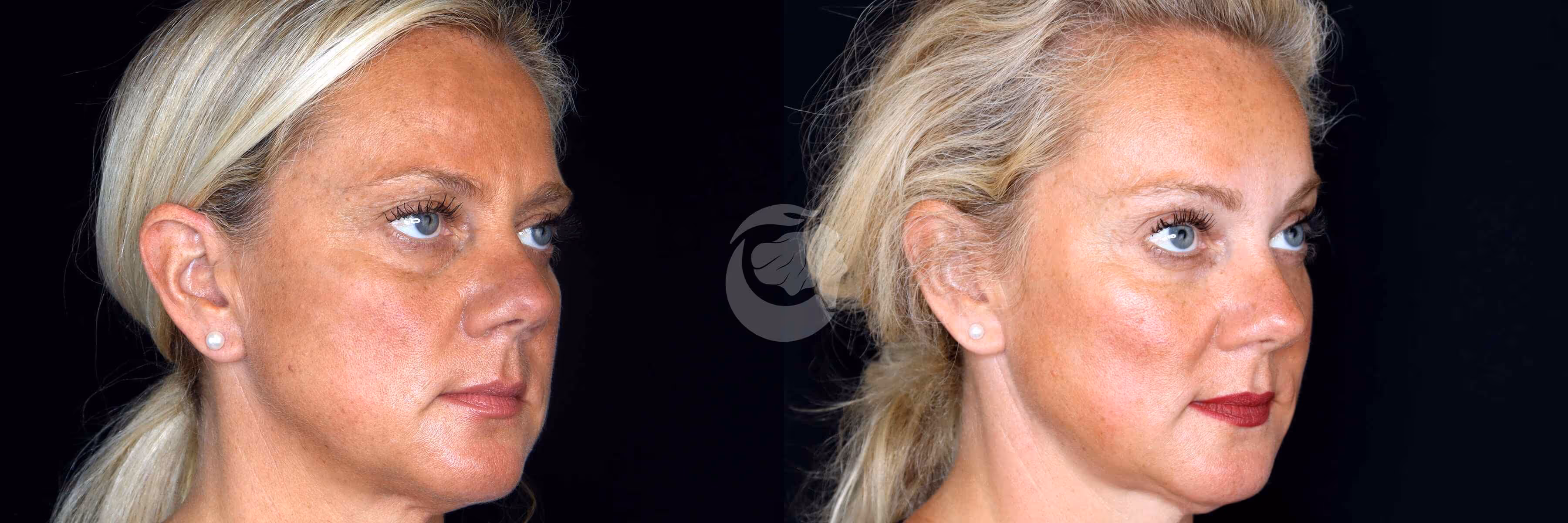 Before And After Patient Image