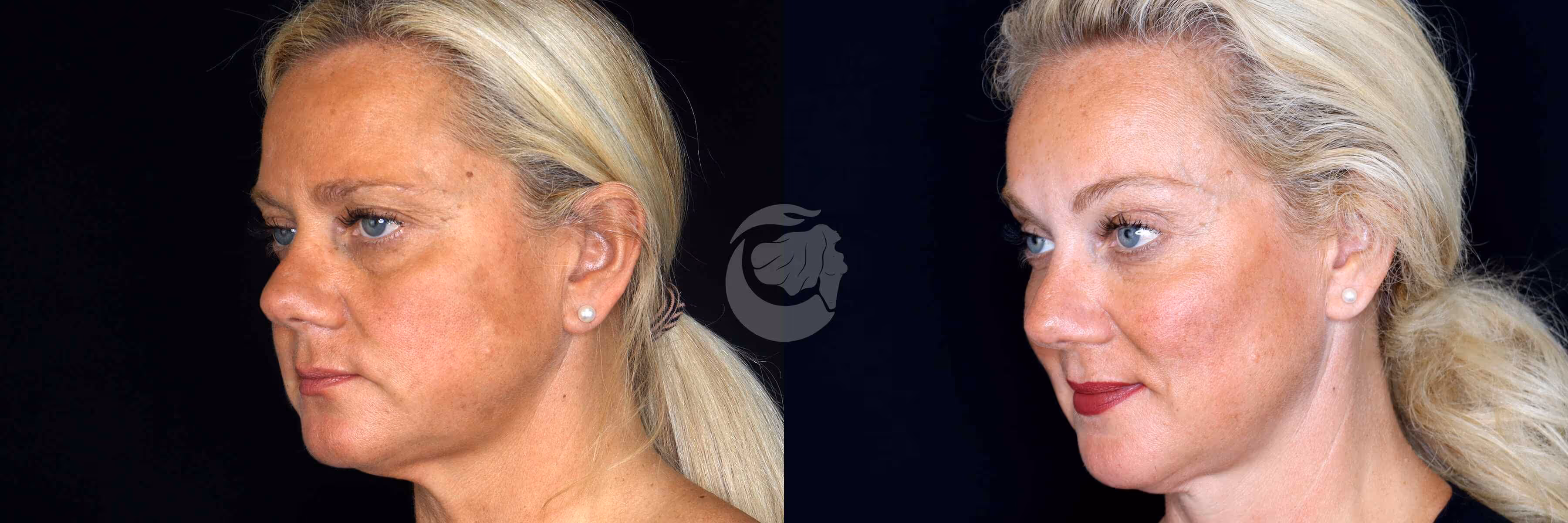 Before And After Patient Image