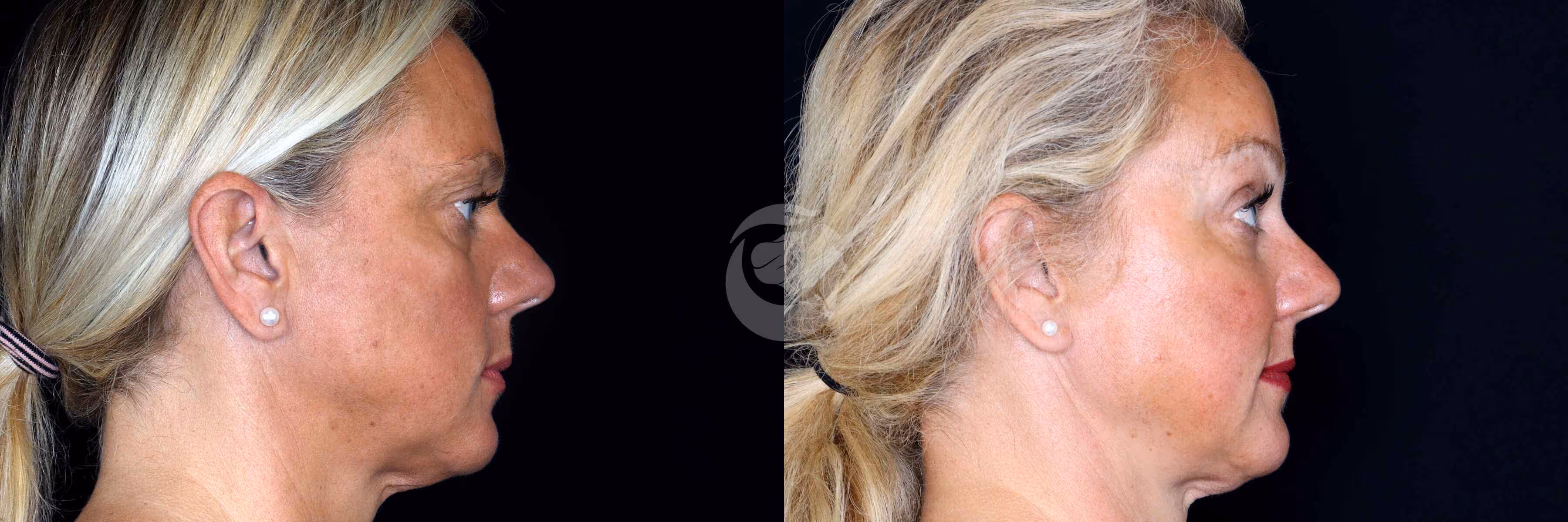 Before And After Patient Image