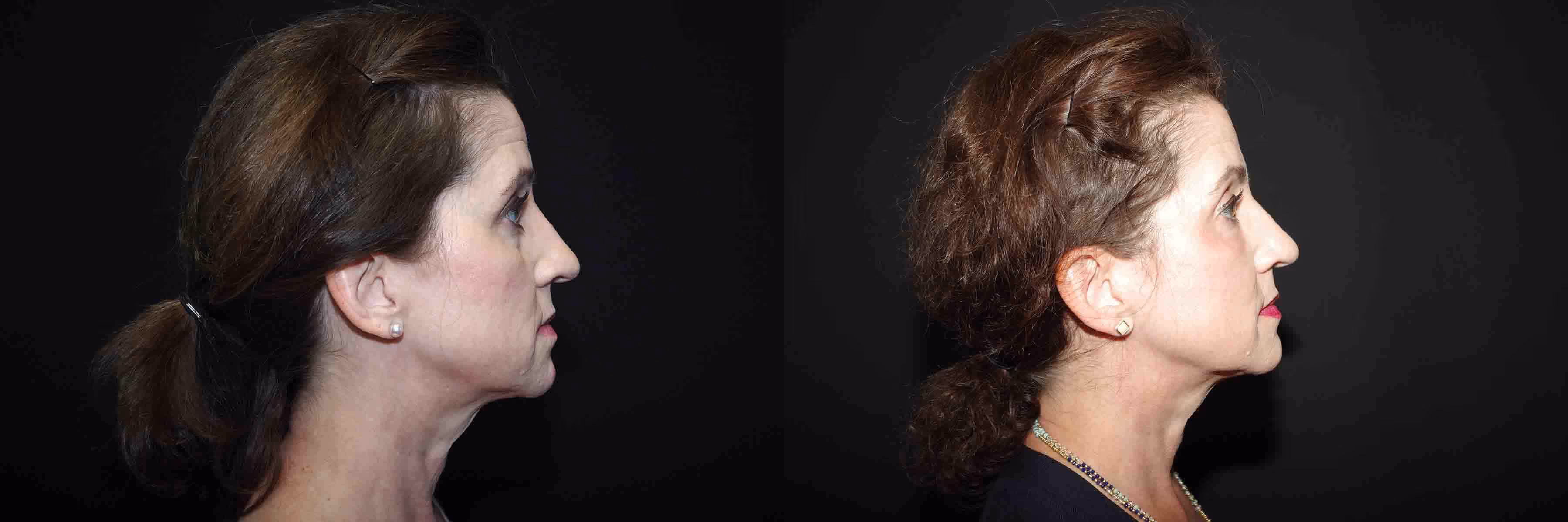 Before And After Patient Image