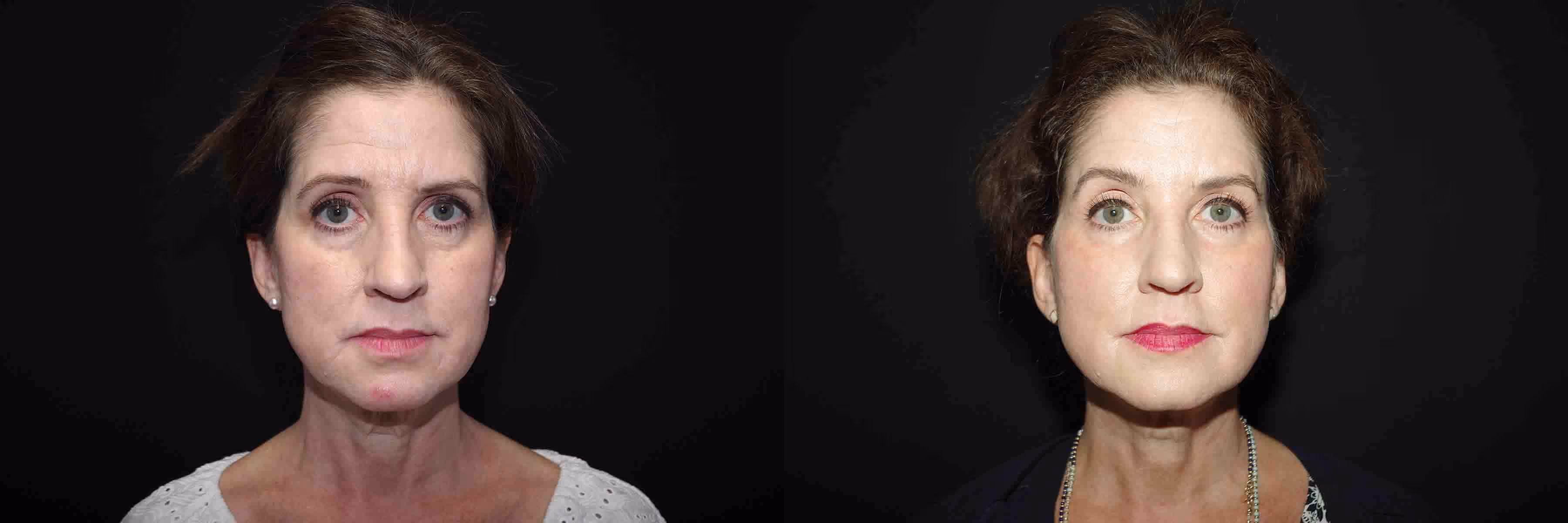Before And After Patient Image