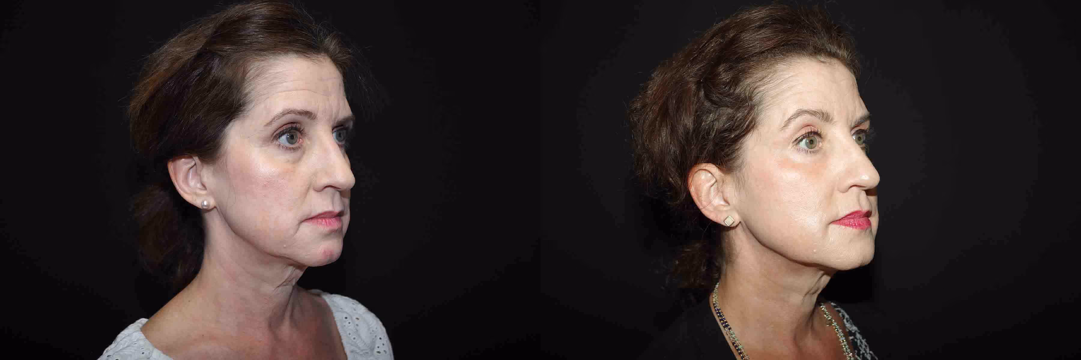 Before And After Patient Image