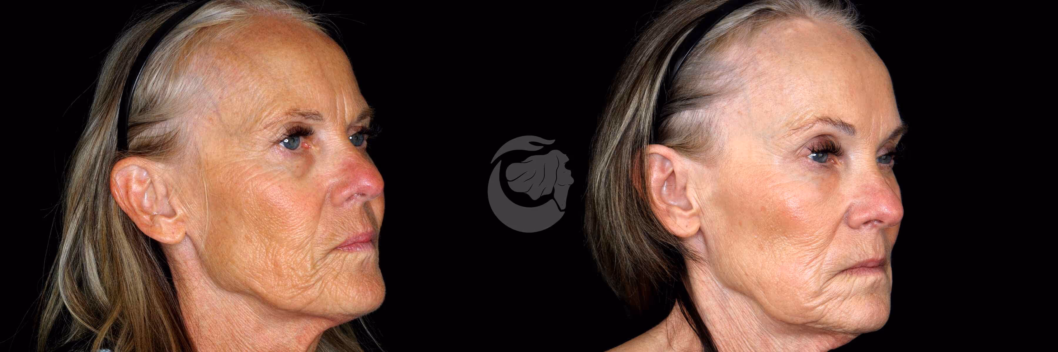 Before And After Patient Image