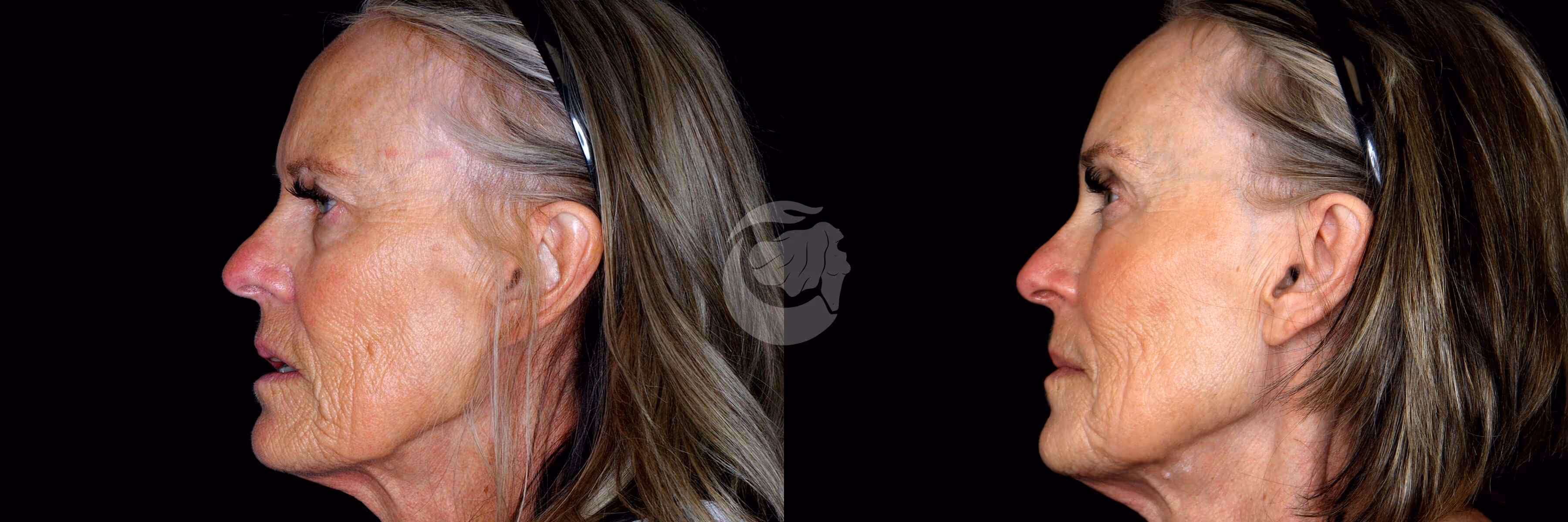 Before And After Patient Image