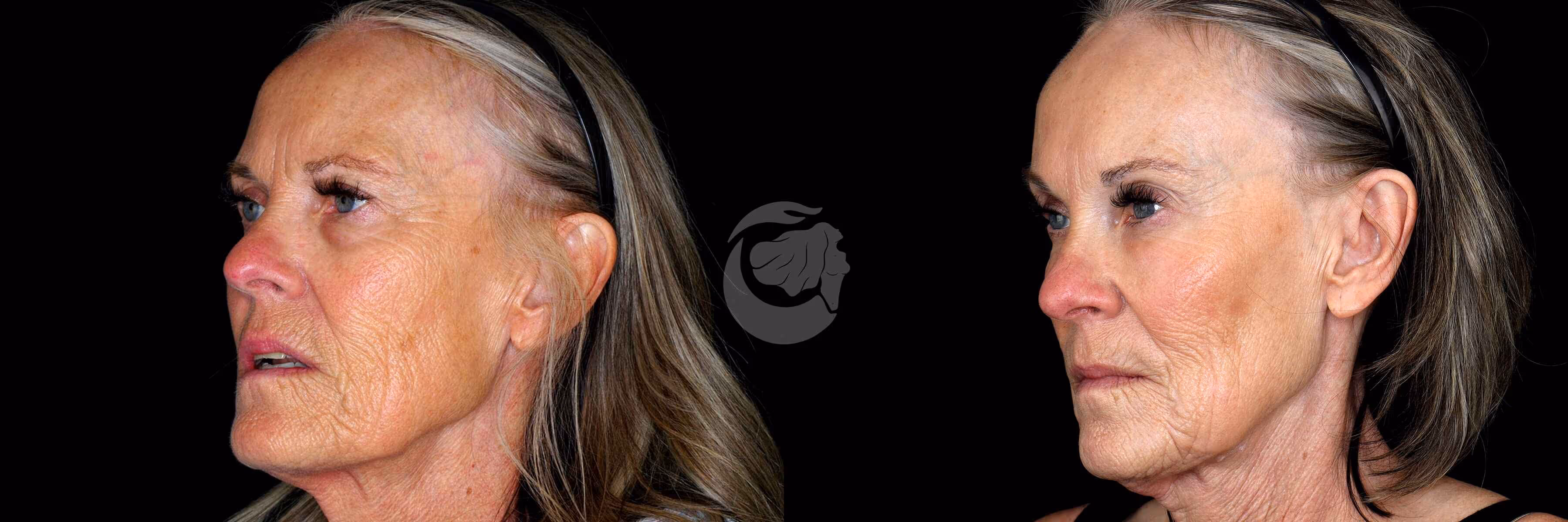 Before And After Patient Image