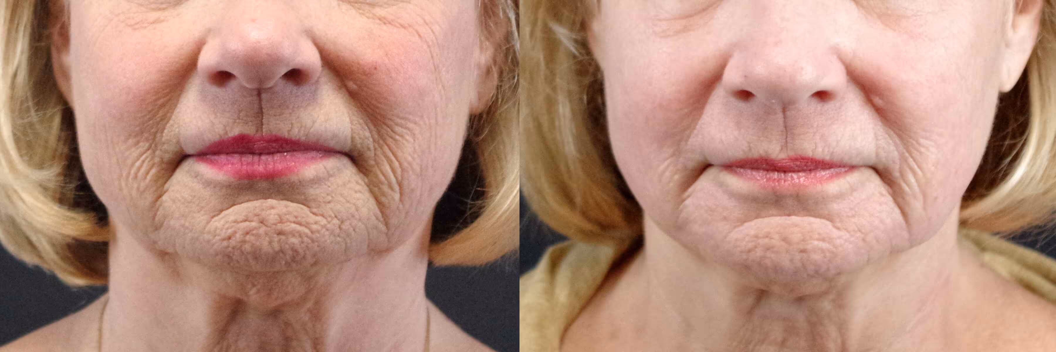 Before And After Patient Image