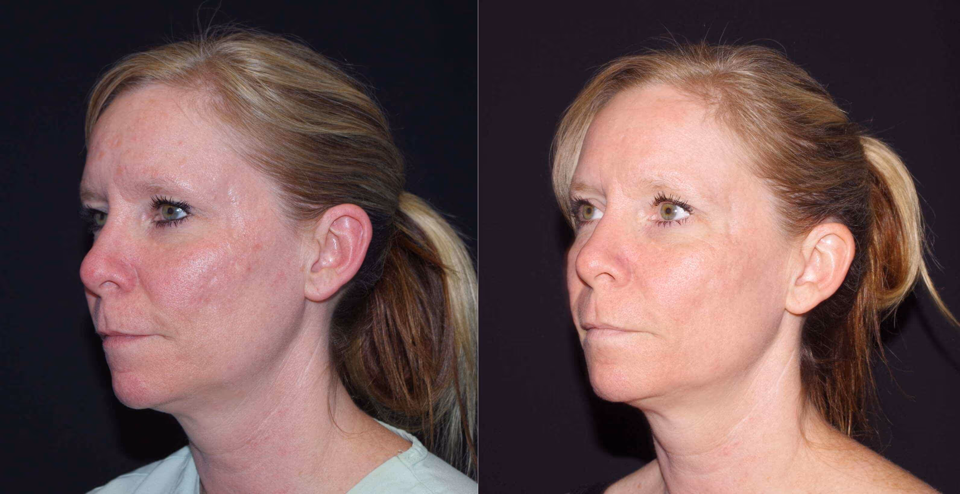 Before And After Patient Image