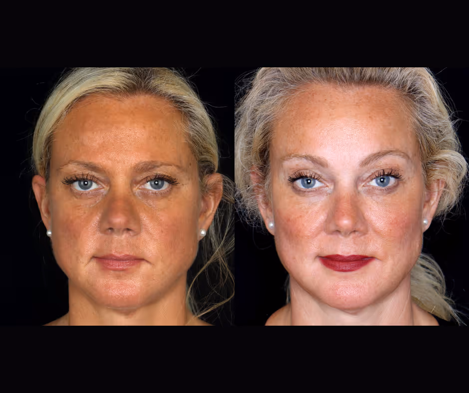 before and after