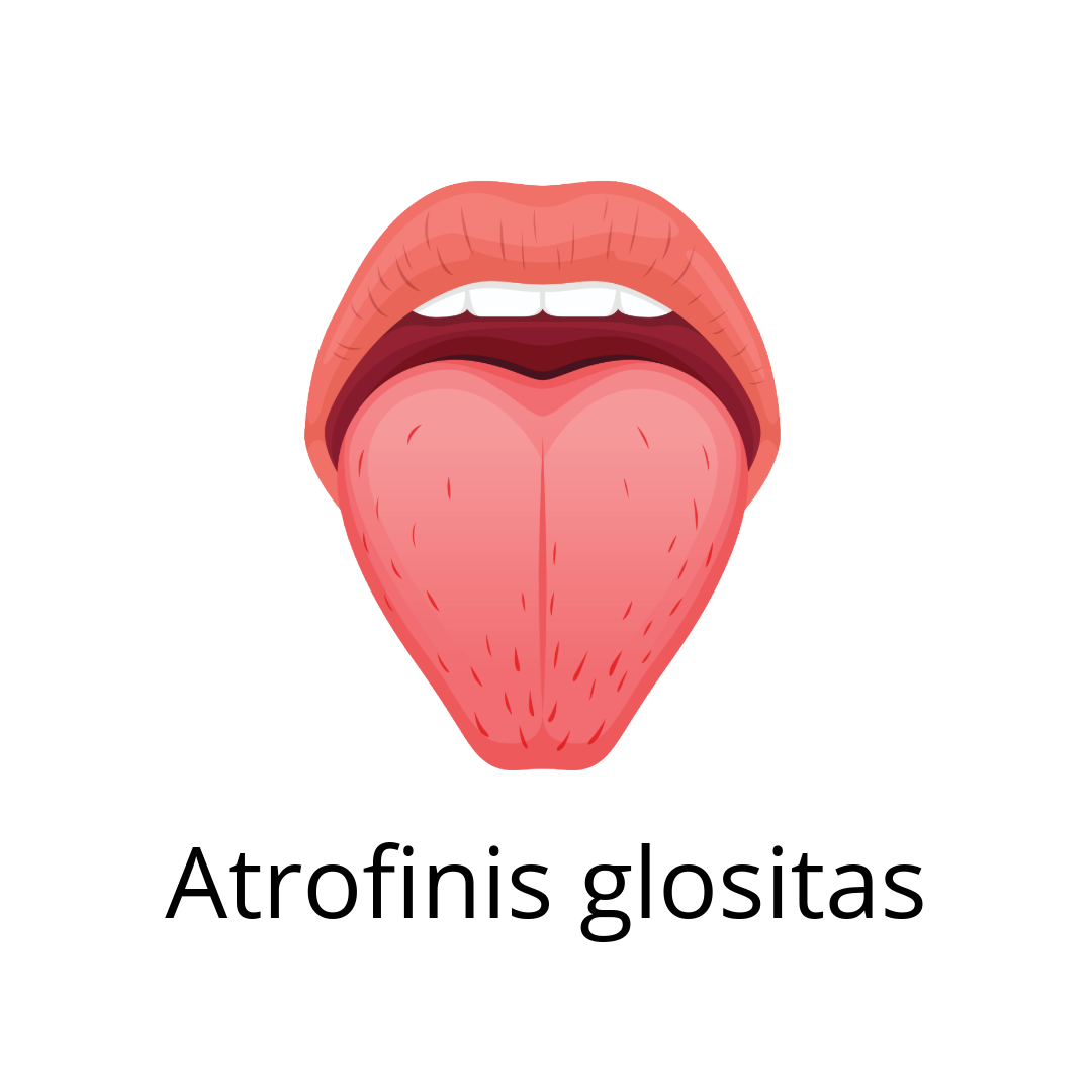 Atrofinis glositas