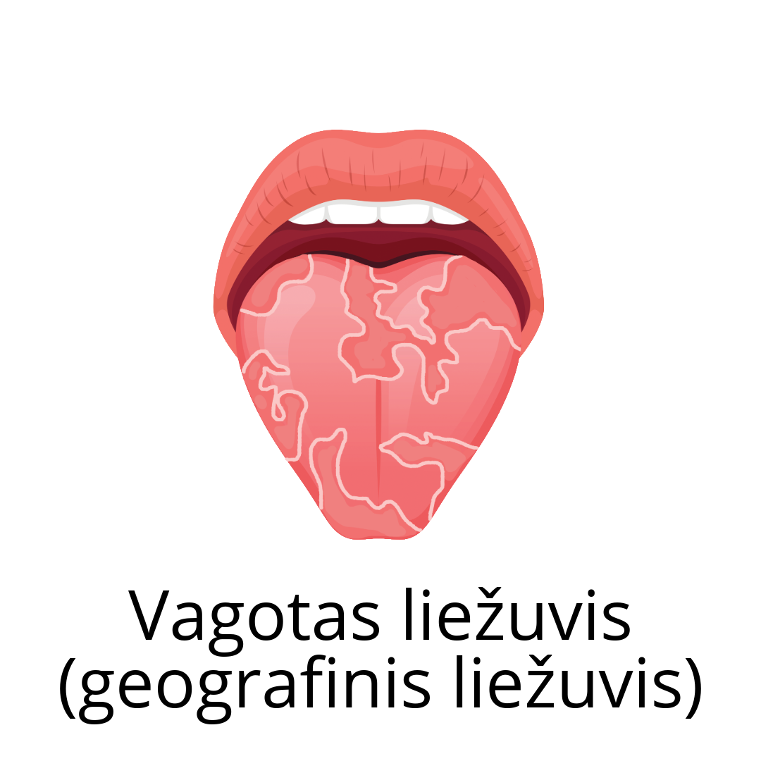 Gerybinis migruojantis glositas (geografinis liežuvis)