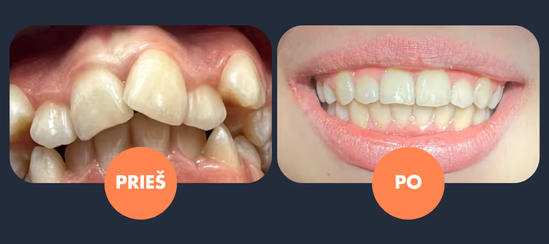 dantų tiesinimas kapomis