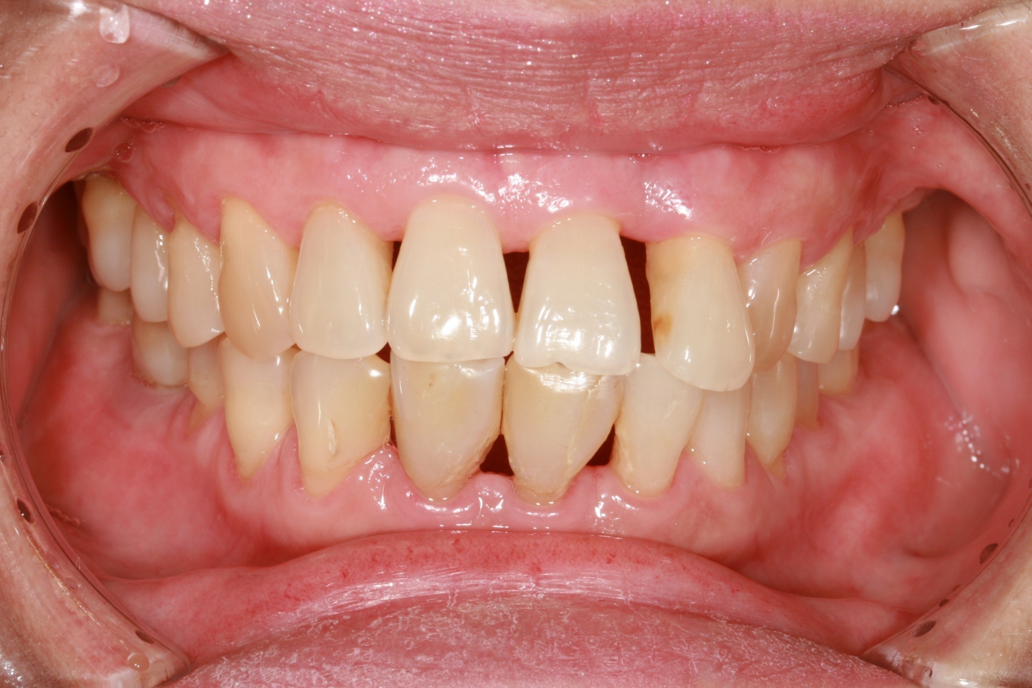 Periodontitas