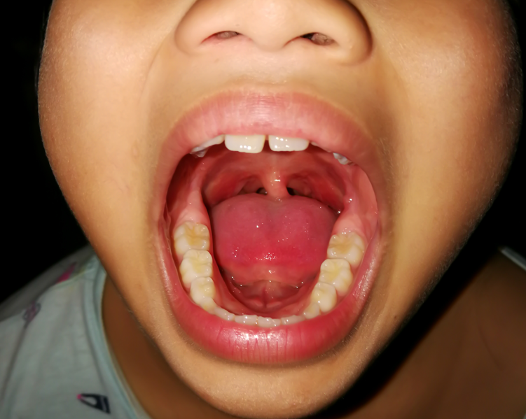 Per trumpas liežuvio pasaitėlis