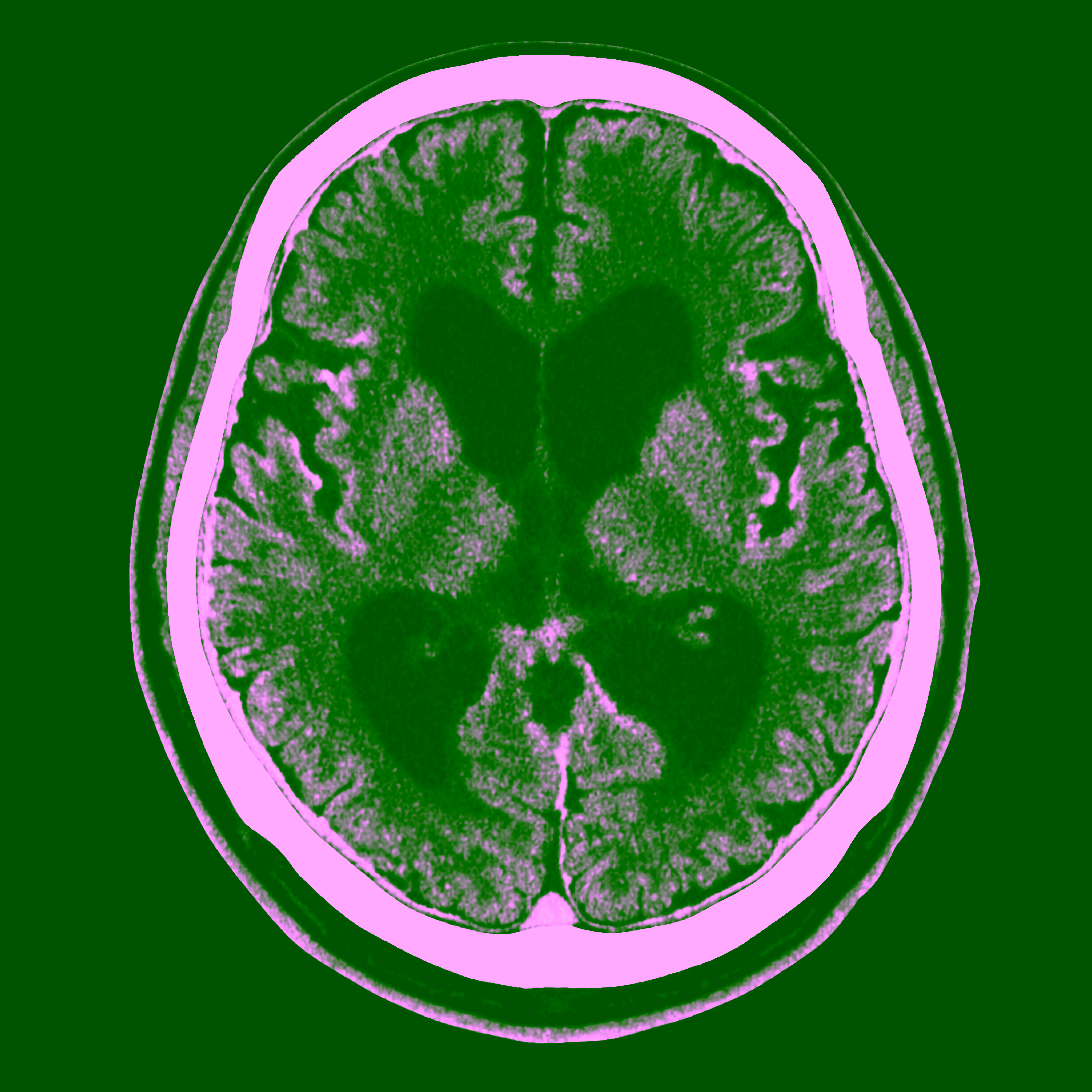 A CT scan of the brain showing dilated ventricles and brain atrophy.