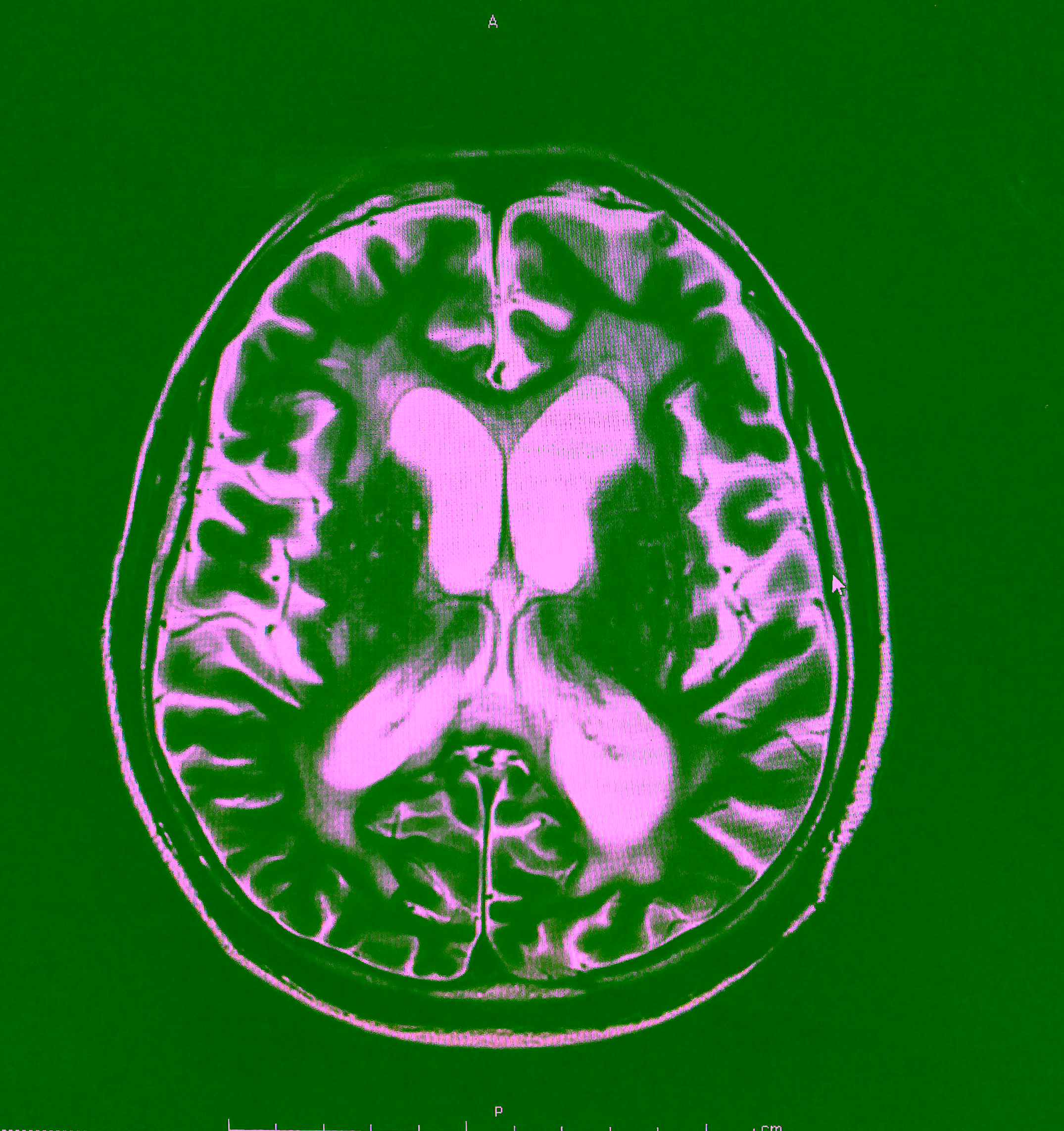 An MRI scan showing dilated ventricles and brain atrophy.