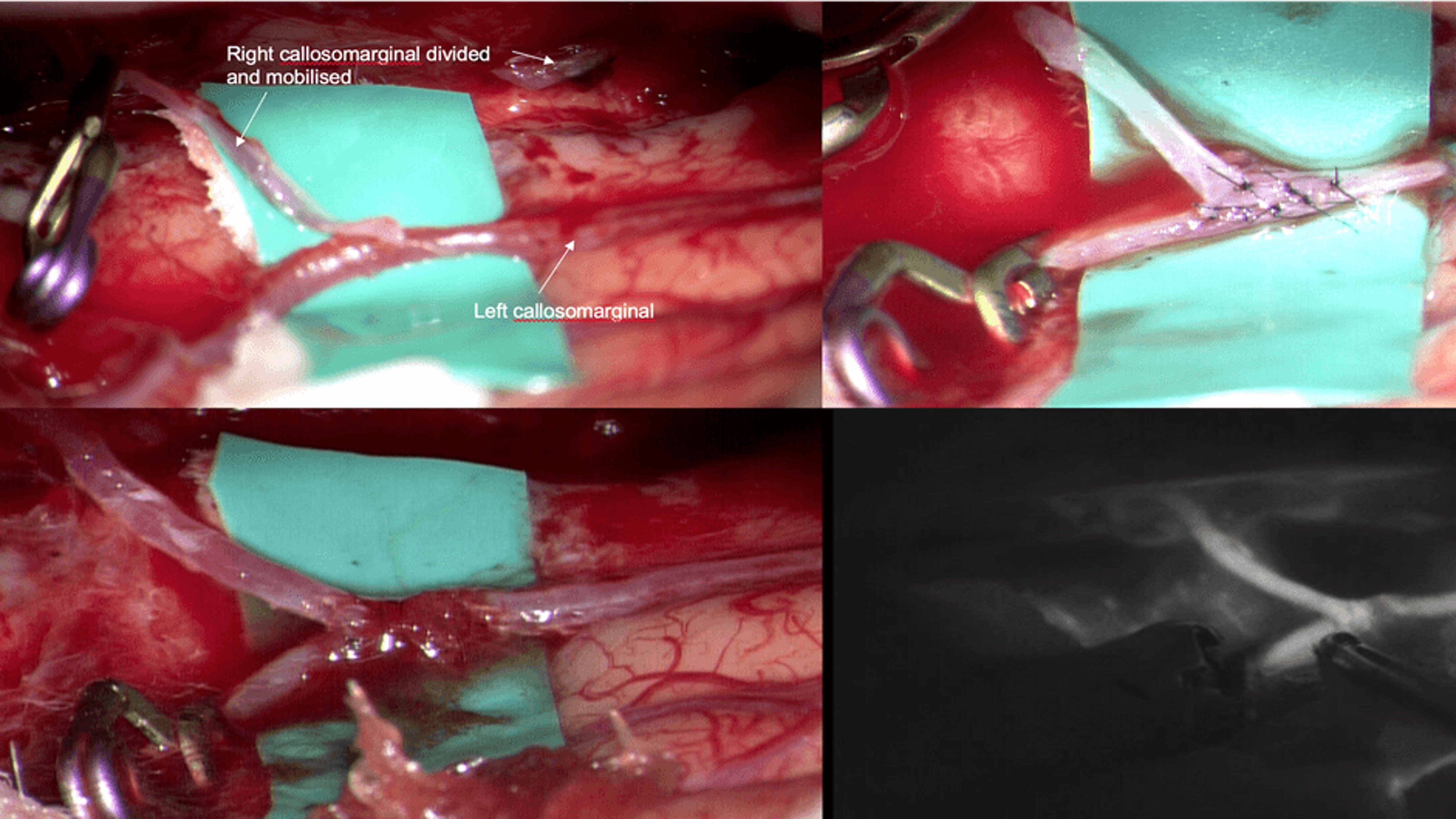 Four-panel image of surgical brain vessels, showing callosomarginal artery division and bypass with sutures.