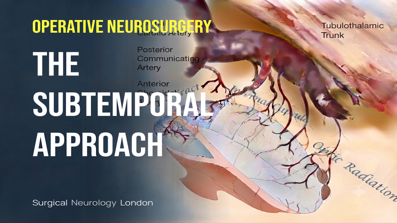 Operative Neurosurgery Video Published- The Subtemporal Approach
