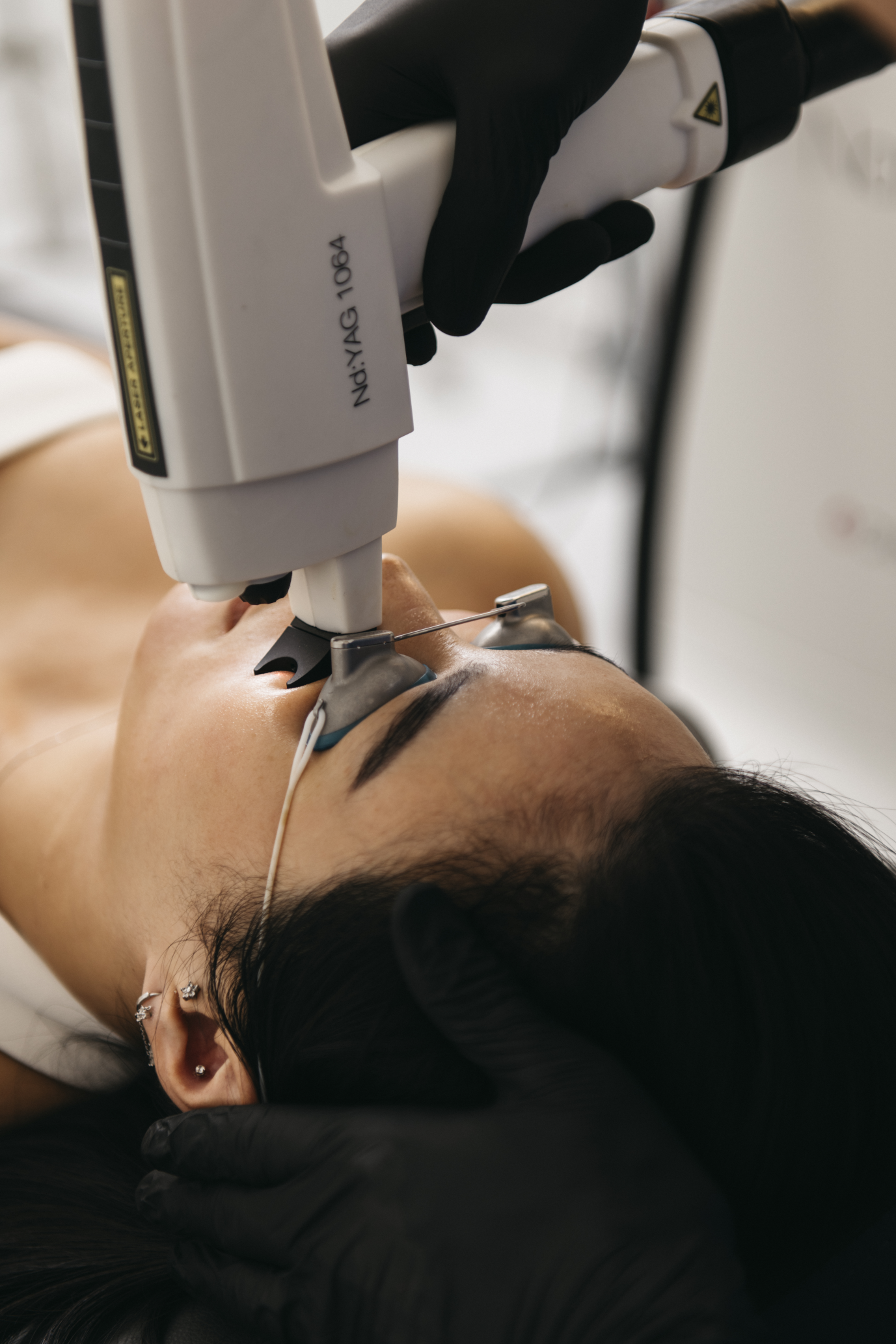 ND Yag Laser Vein Reduction