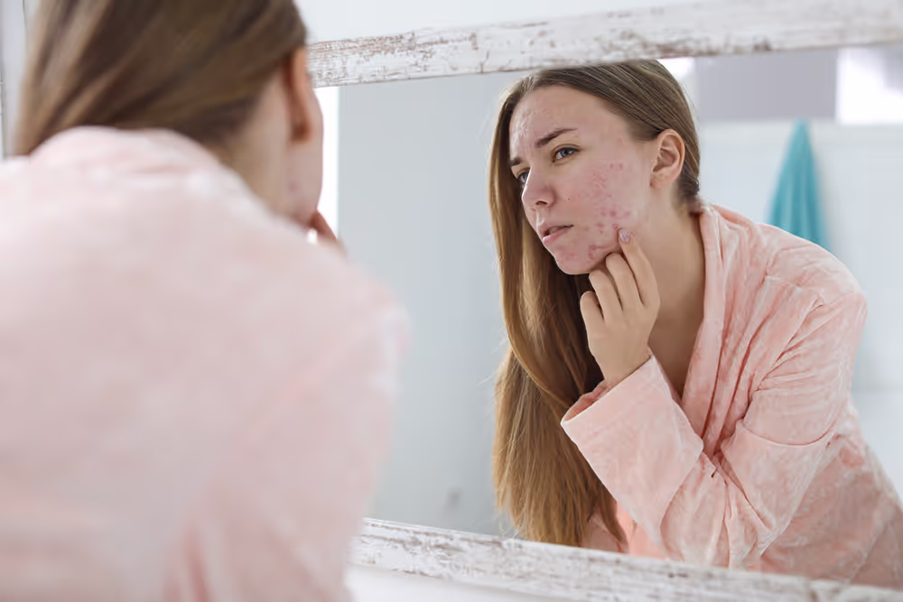 Does Drinking Alcohol Cause Acne?