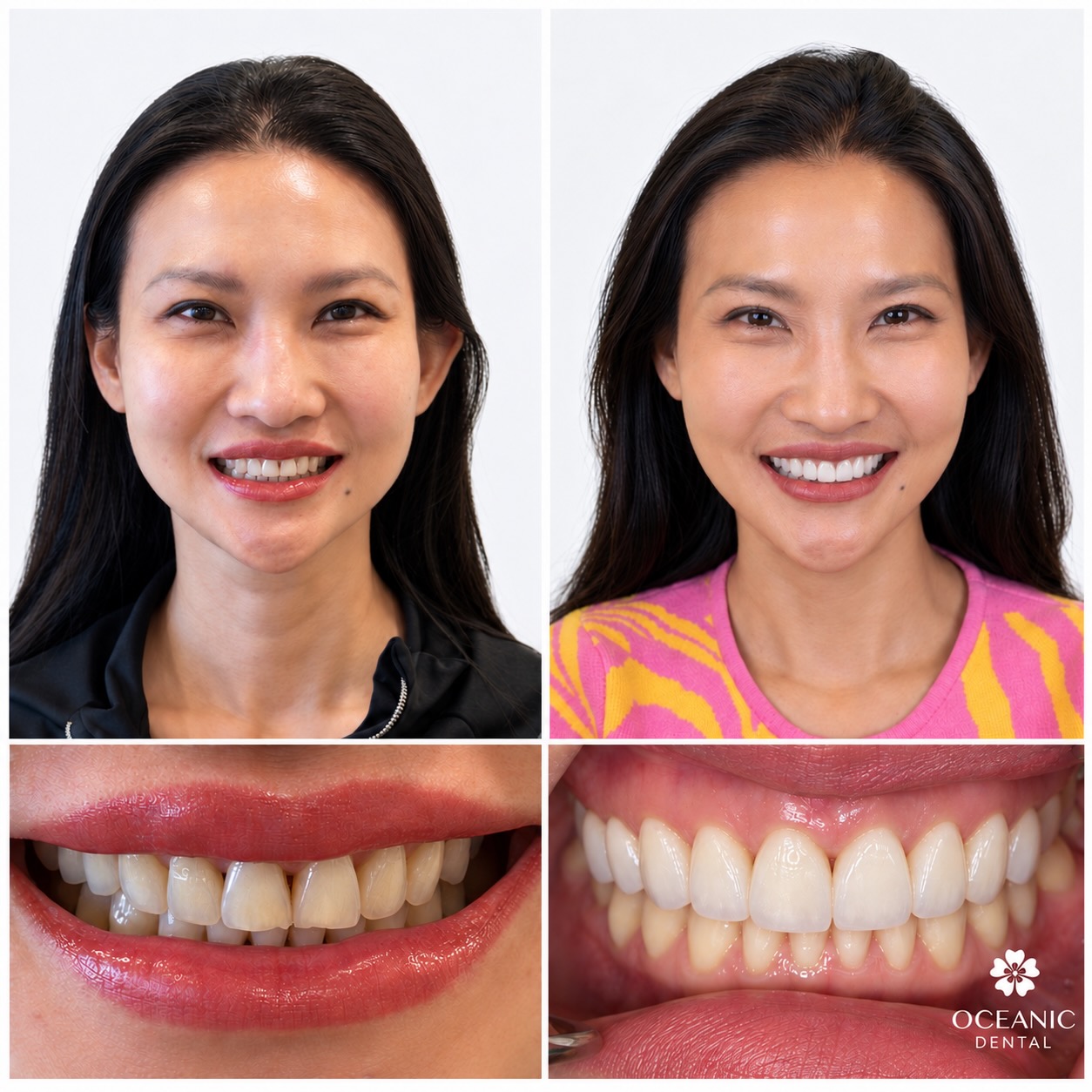 Before and after collage of a Oceanic's patient's smile makeover showing her face and close-up views of her teeth; before photos show uneven, discolored teeth with gaps, and after photos show straighter, whiter teeth with a more even smile, labeled with Oceanic Dental logo.