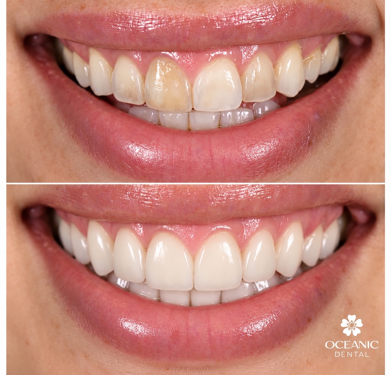 Close-up comparison of a smile before and after no-prep dental treatment showing discolored, uneven upper front teeth with stains in the top image and bright, evenly shaped, white teeth in the bottom image.