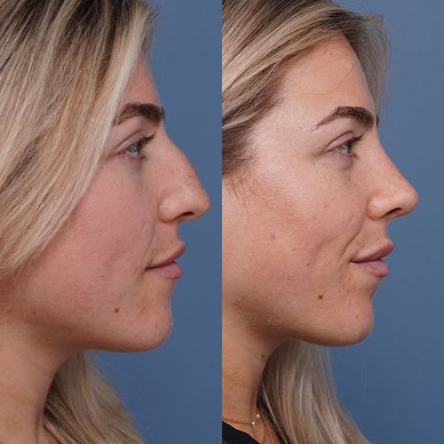 Before & After Rhinoplasty