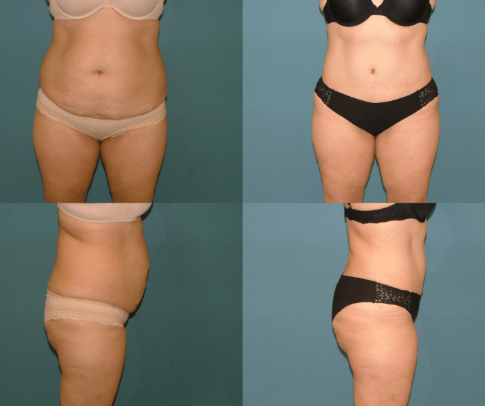 mini tummy tuck before and after
