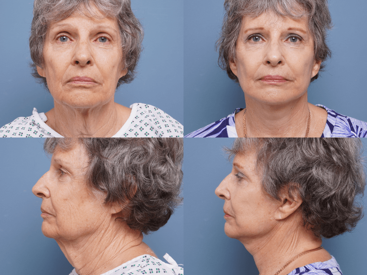 Facelift Before & After