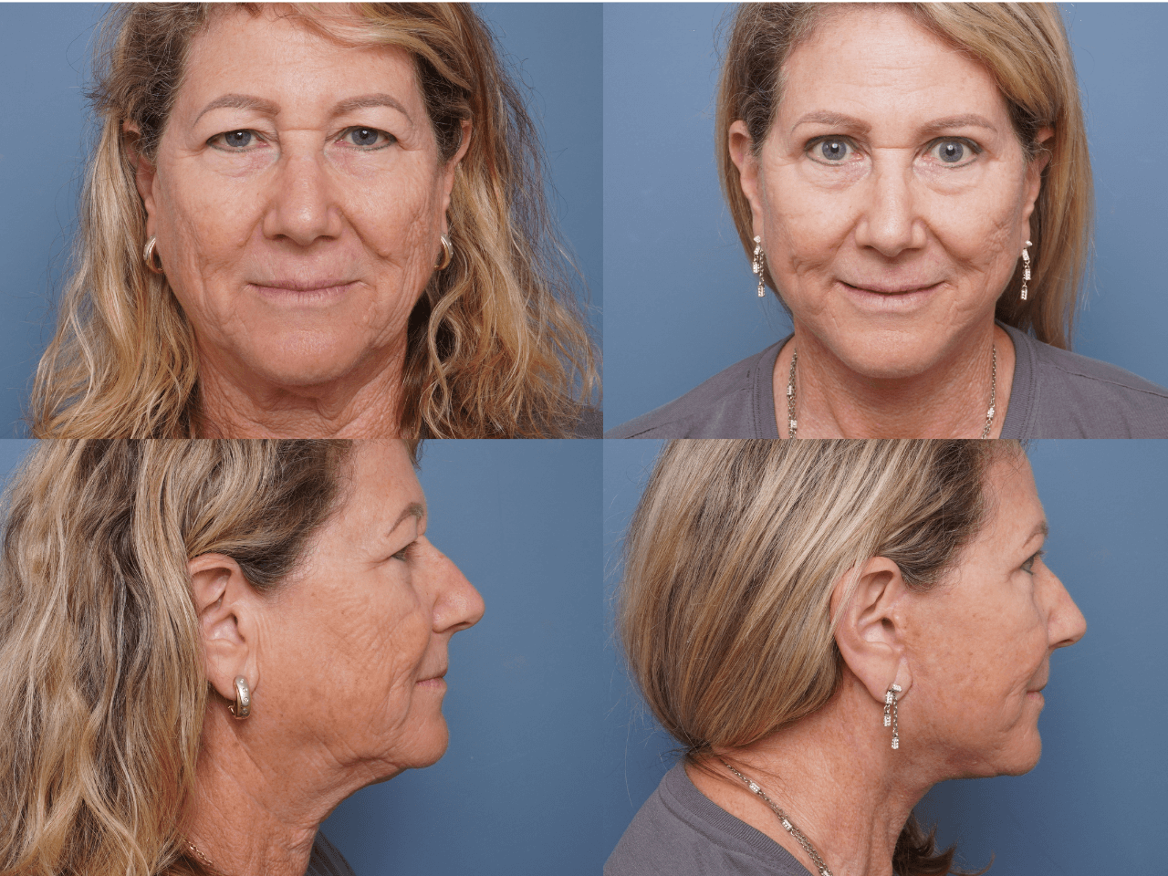 Facelift Before & After