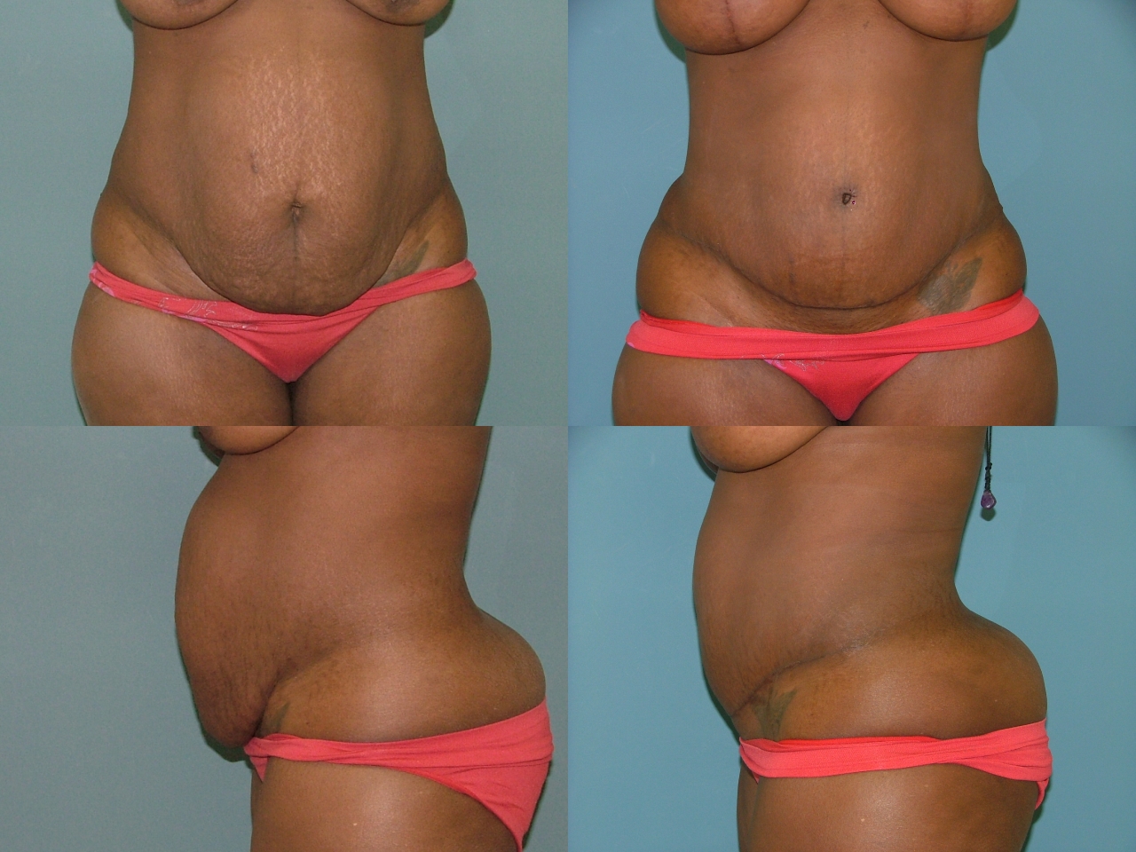 Tummy Tuck 1