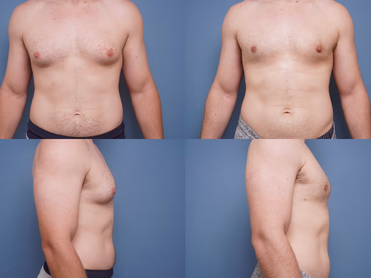 Tummy Tuck 1