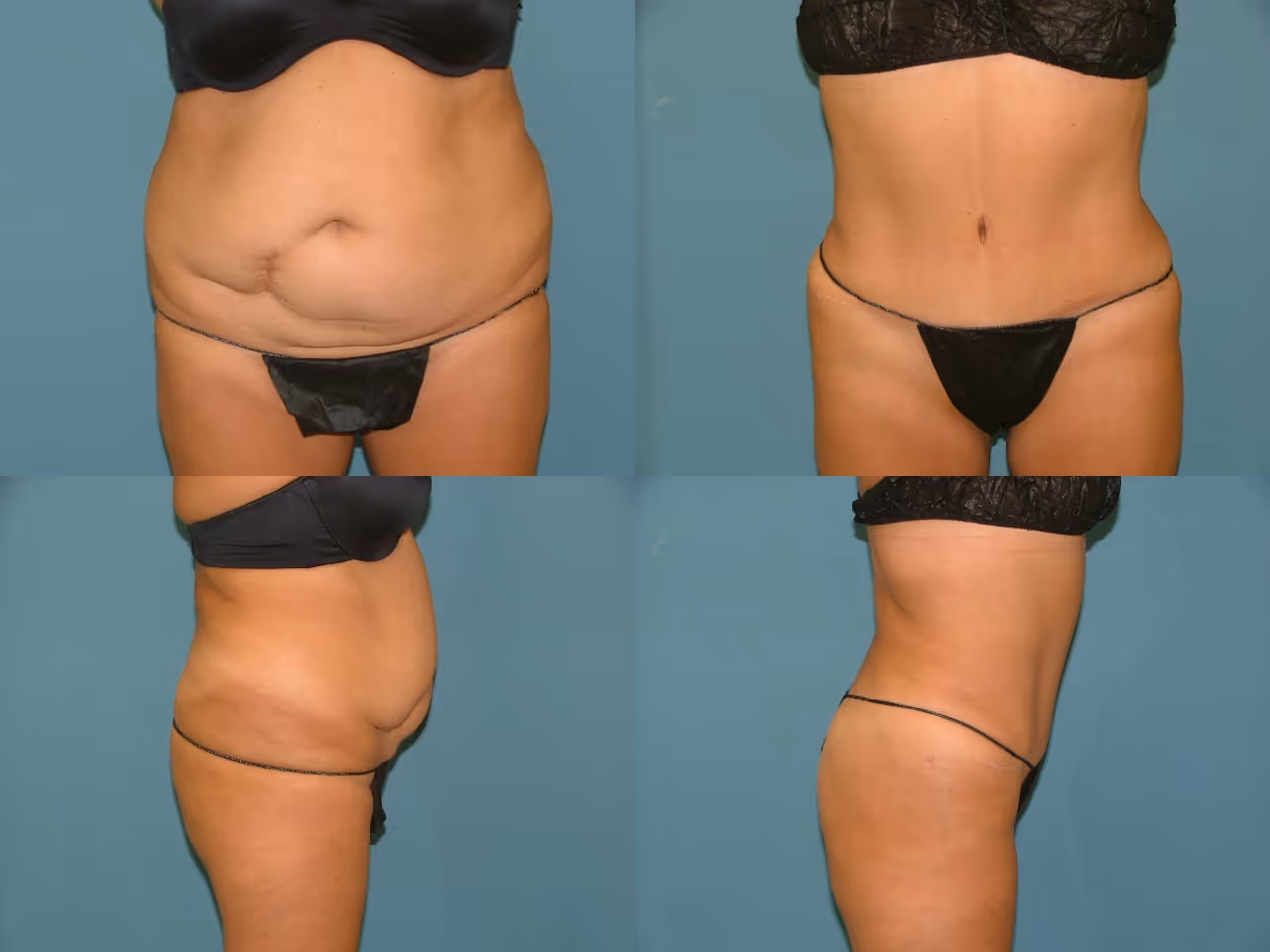 Tummy Tuck 1