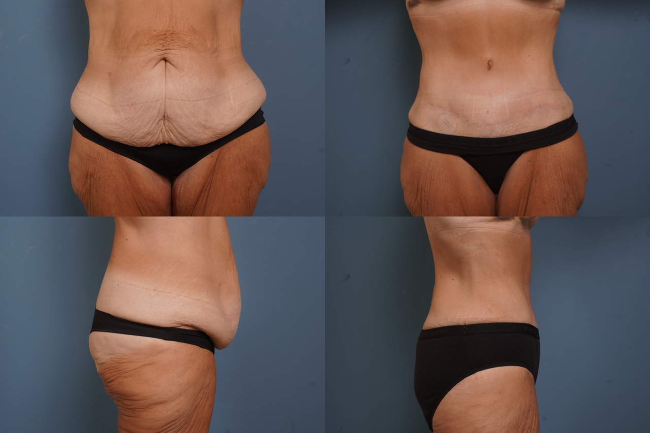 Tummy Tuck 