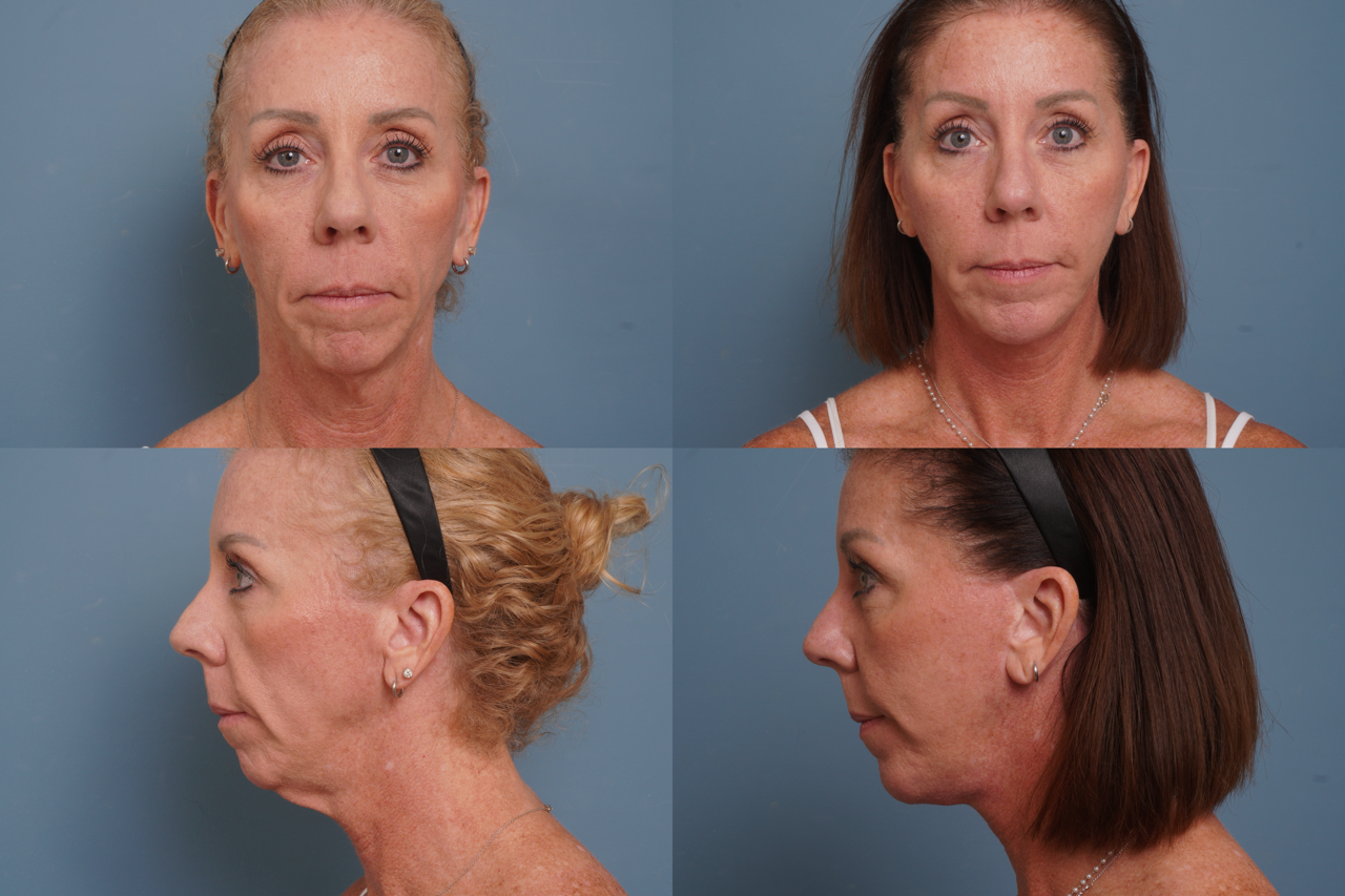 Facelift Before & After