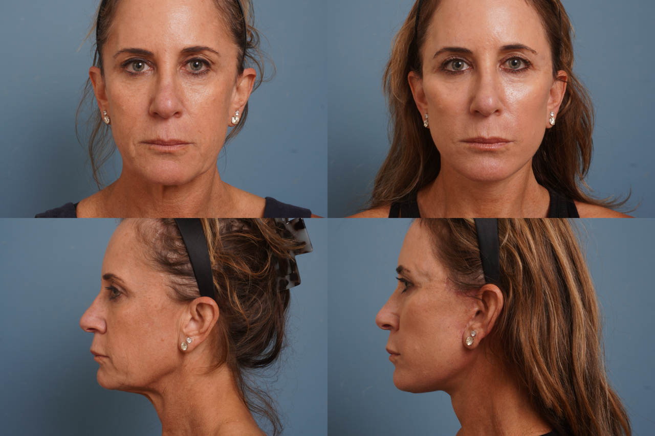 Facelift Before & After