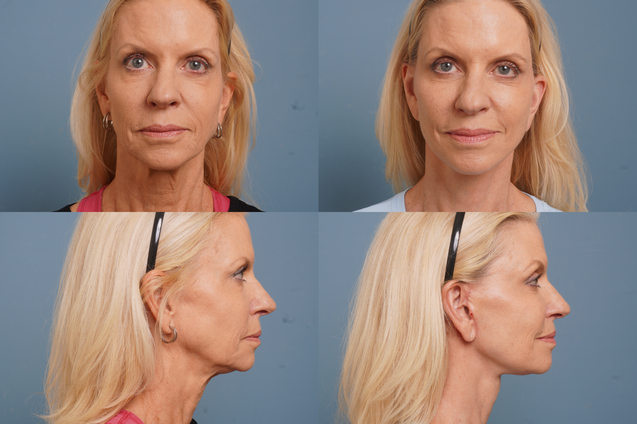 Facelift Before & After
