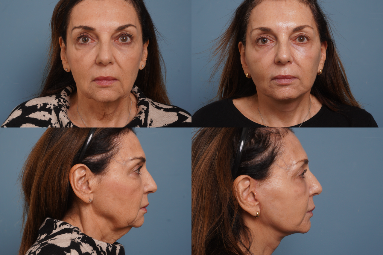 Facelift Before & After