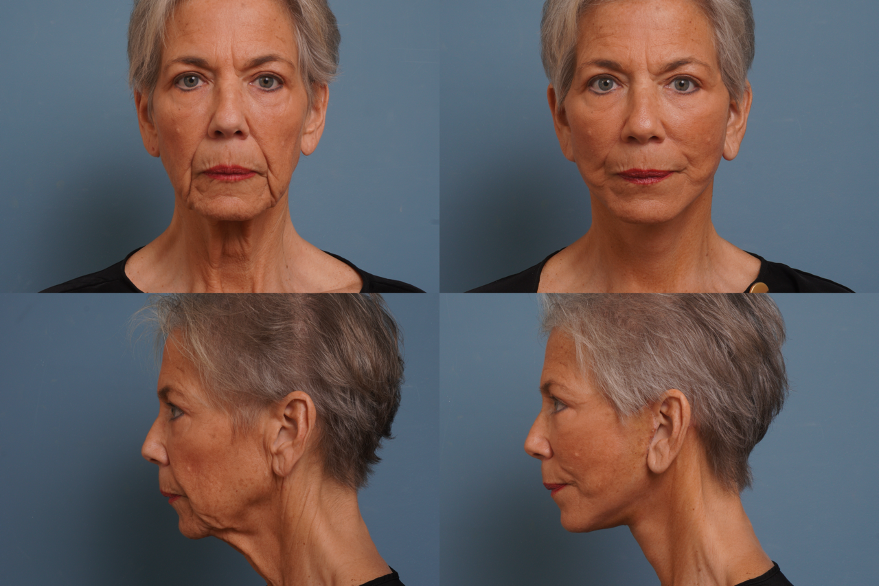 Facelift Before & After