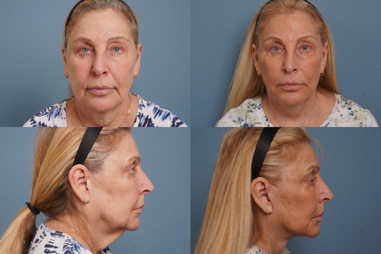 Facelift Before & After