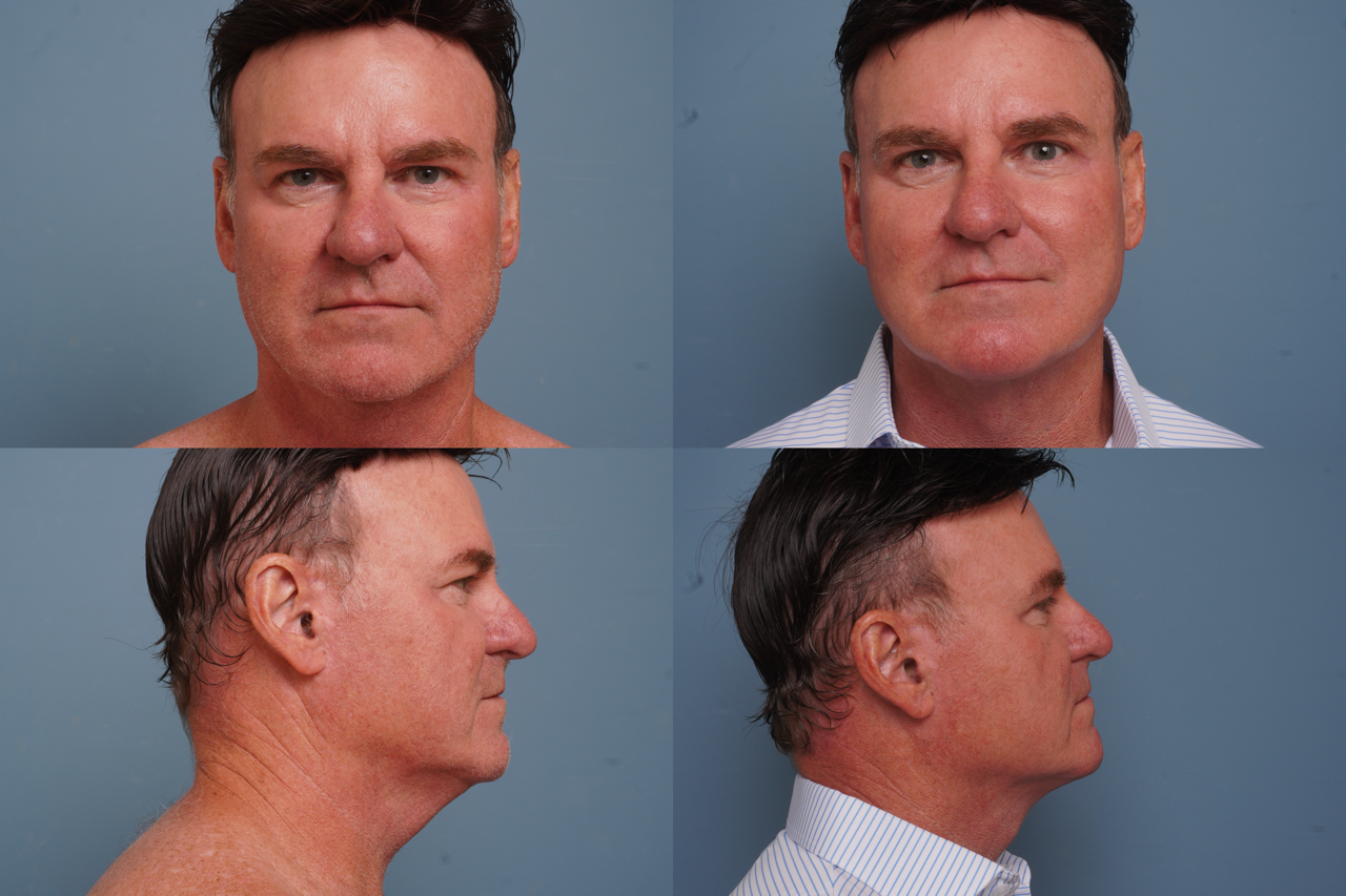 Facelift Before & After