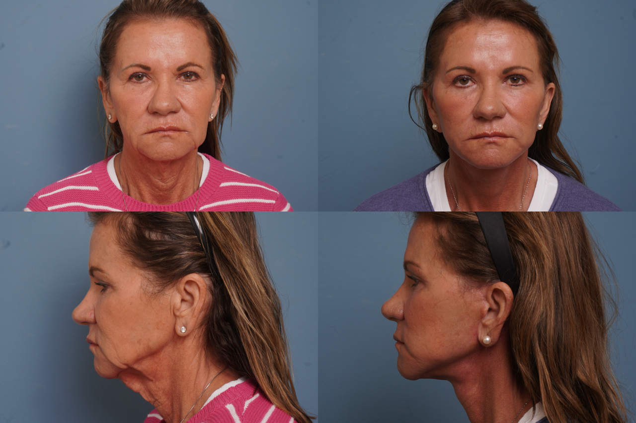 Facelift Before & After