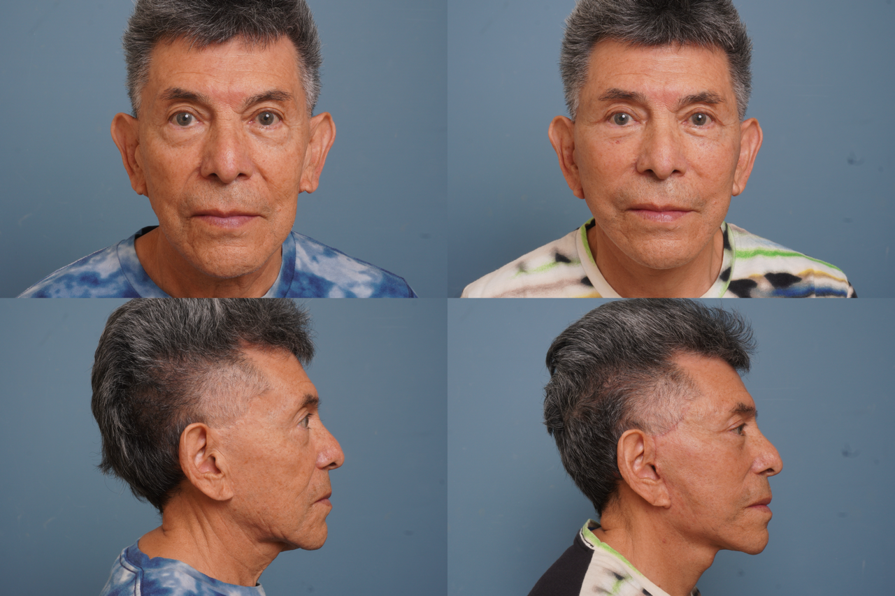 Facelift Before & After