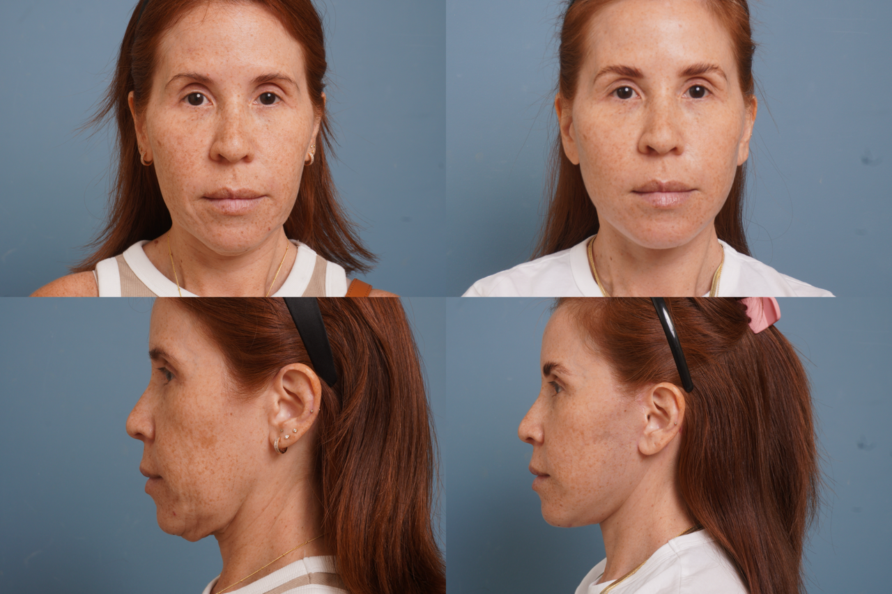 Facelift Before & After