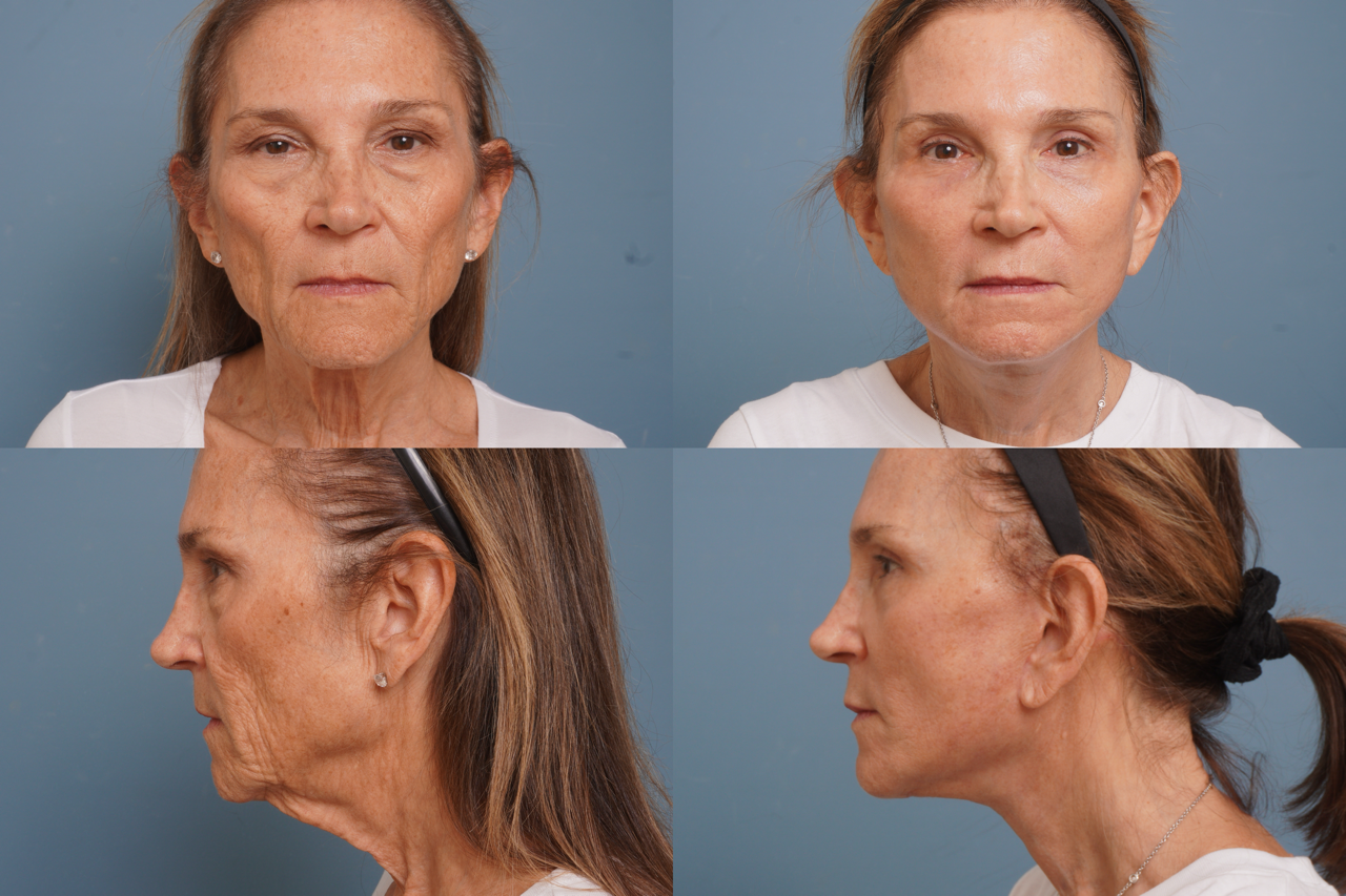 Facelift Before & After