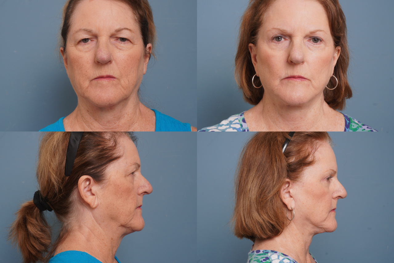 Facelift Before & After