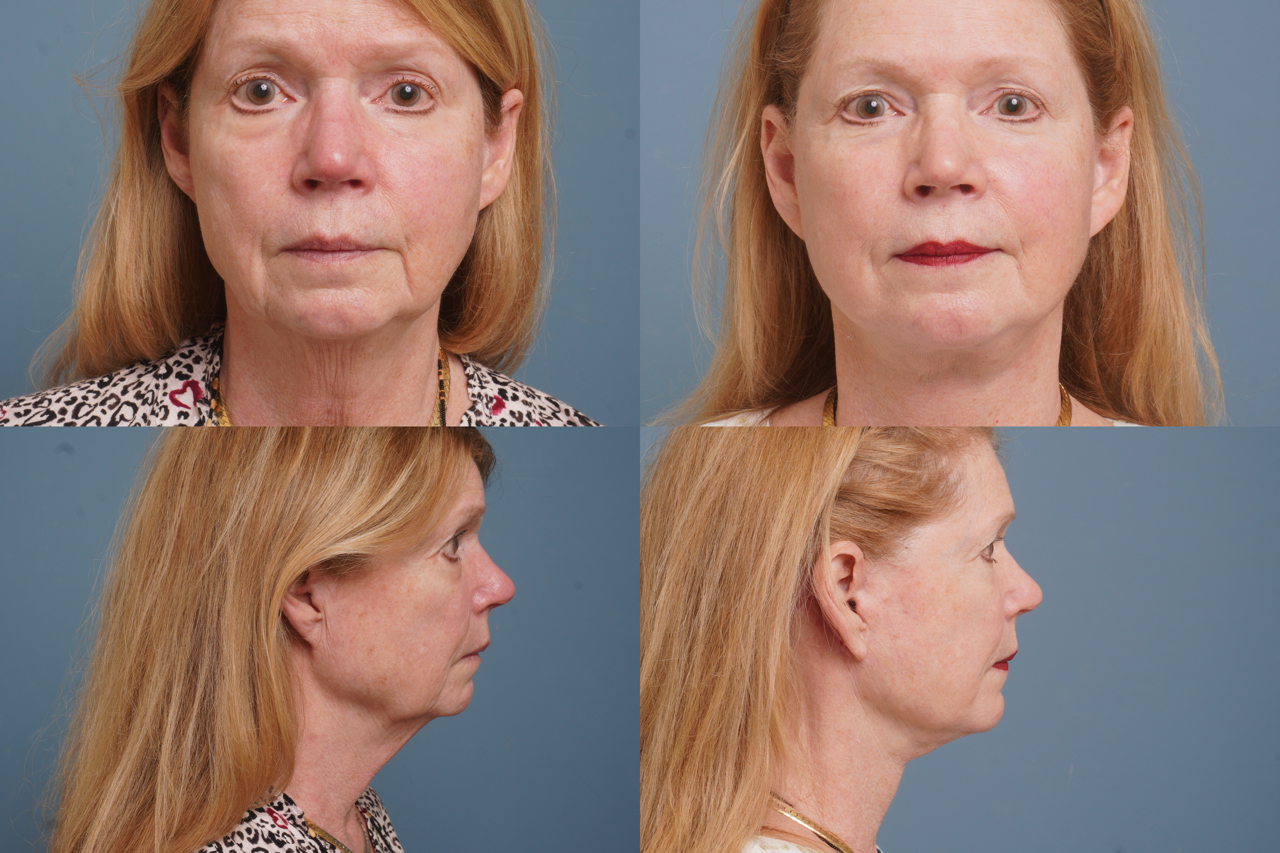 Facelift Before & After